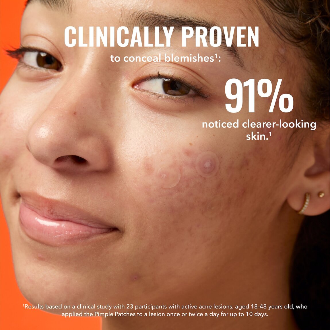 pimple-patches-a6 zb_p.jpg