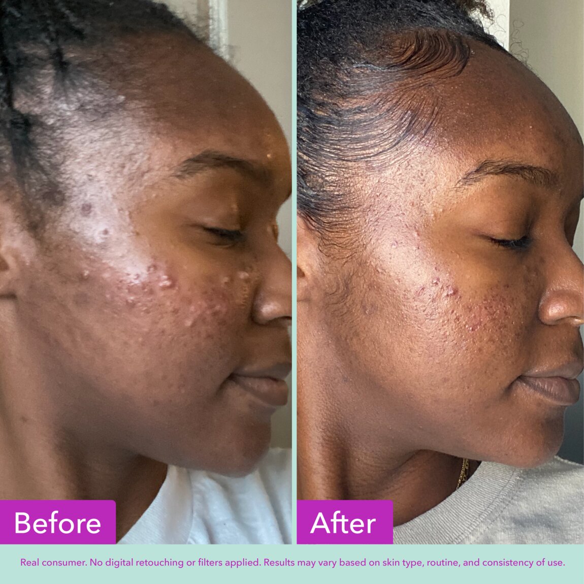 acne-foaming-cleanser-x2 zb_p.jpg